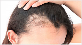 Treatment for Alopecia