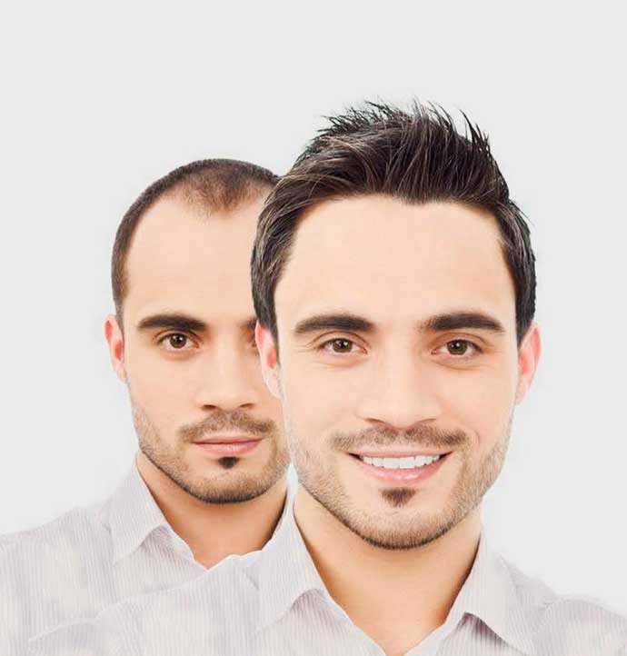 Hair Transplant Qualify