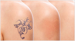 Laser Tattoo Removal